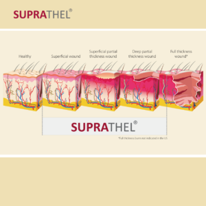 04.	Introduction to Burns and Wounds